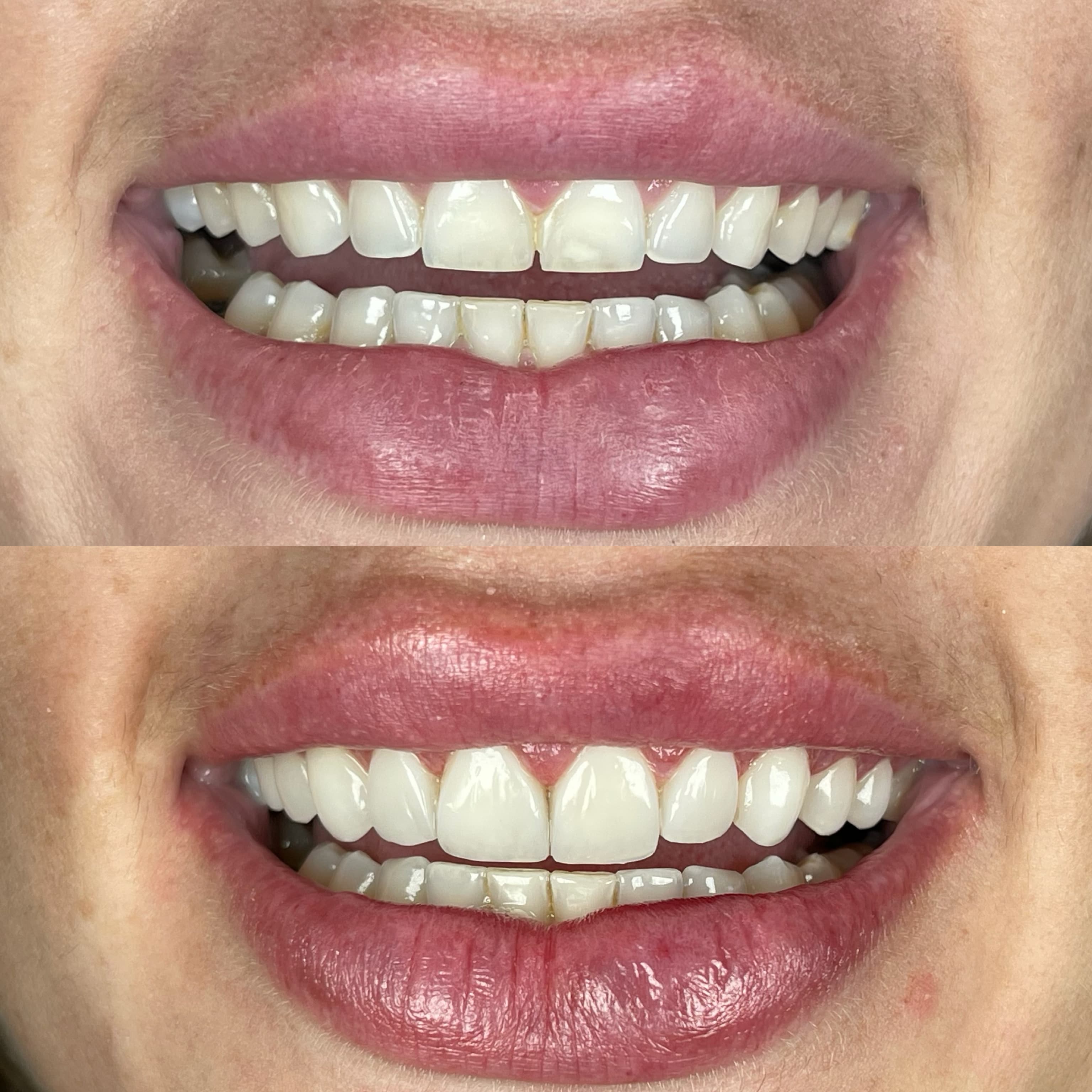 Resultado de implante dentário - Caso 1