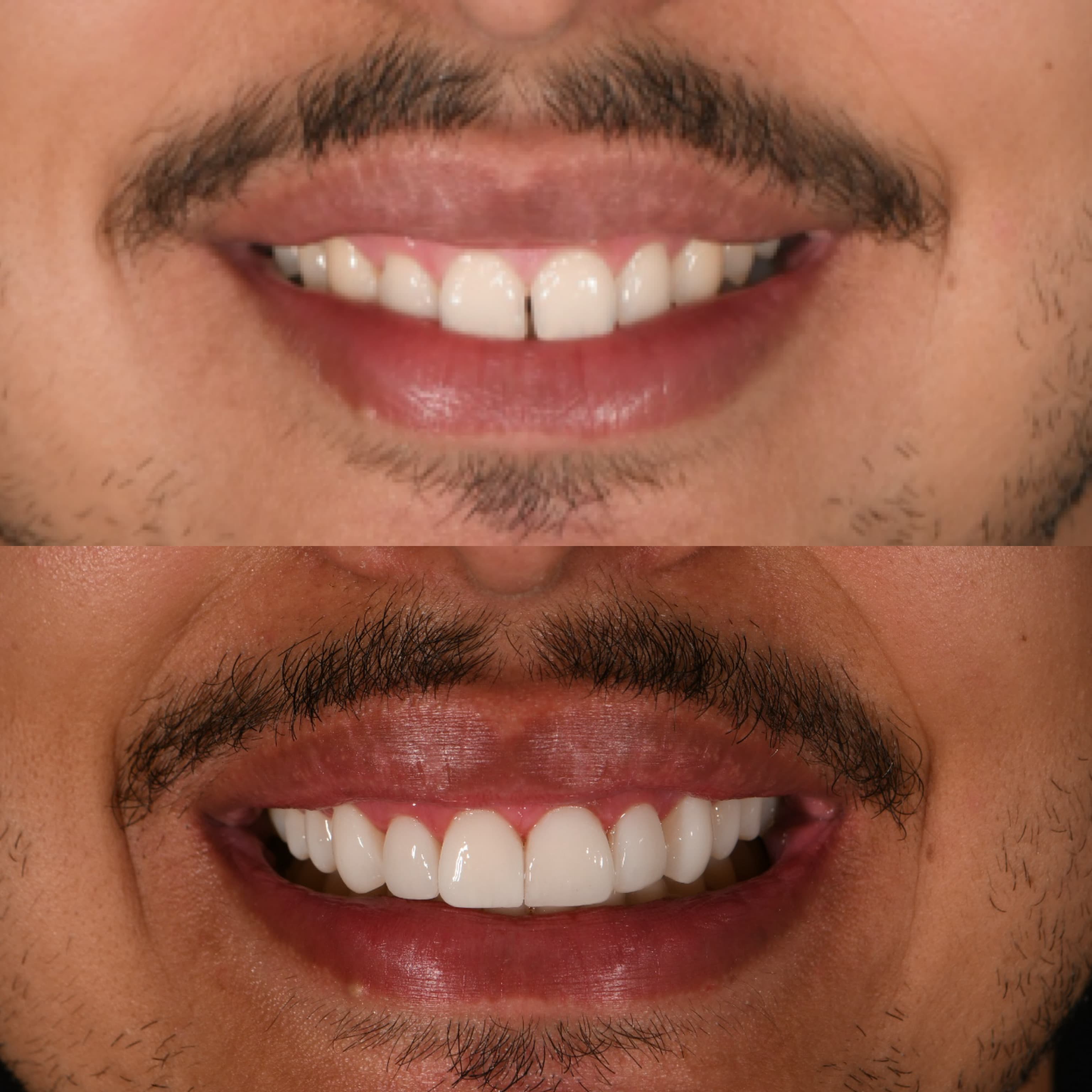 Resultado de implante dentário - Caso 2